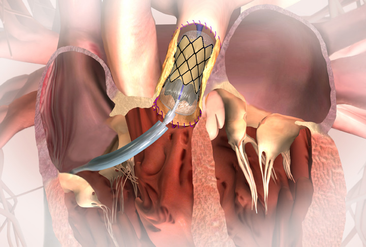 You are currently viewing TAVR or TAVI at Viveka Hospitals